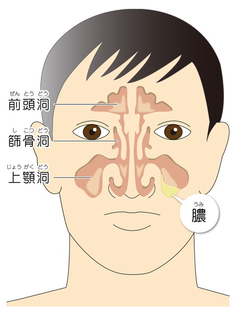 鼻づまりや頭痛がある副鼻腔炎