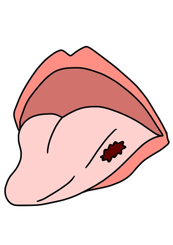 舌がん