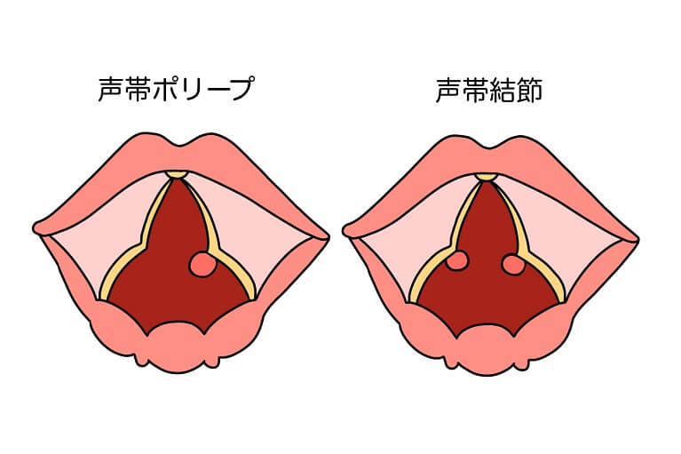 声帯結節