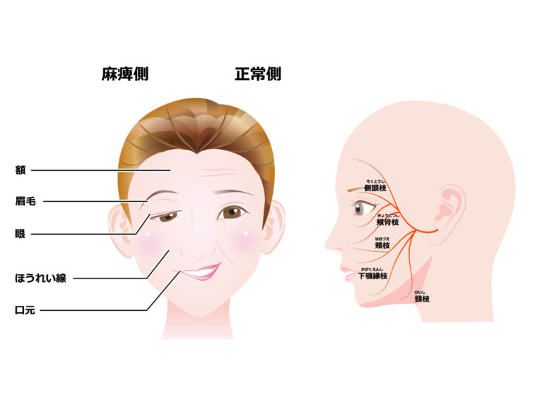 顔の半分が動かしづらい？顔面神経麻痺とは